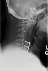 XRAY CERVICAL SPINE 2 OR 3 VIEWS 0001.jpg
